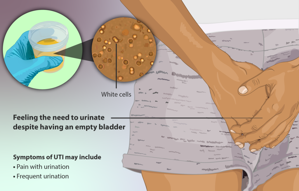 मूत्र मार्ग संक्रमण - Urinary Tract Infections 1 मूत्र मार्ग संक्रमण – Urinary Tract Infections